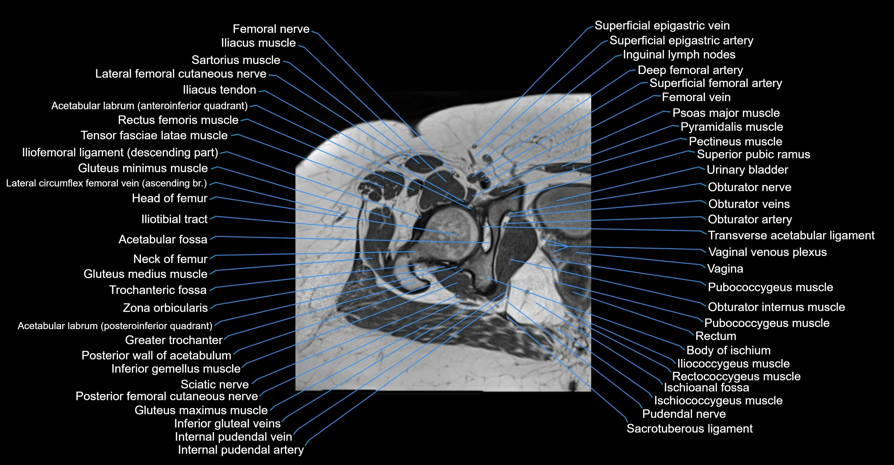 MRI hip axial cross sectional anatomy 3T 3D  radiology  anatomy image-img-00001-00042.webp